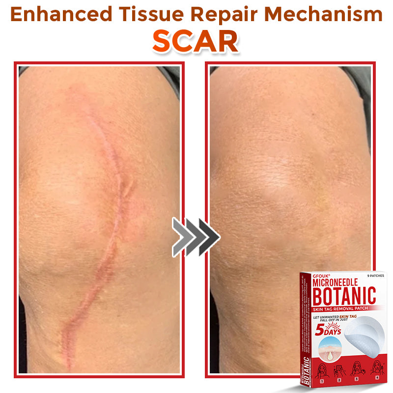 ❤️GFOUK® MicroNeedle Skin Tag Remover Patches - Botanic Formula | Fast Acting Australia