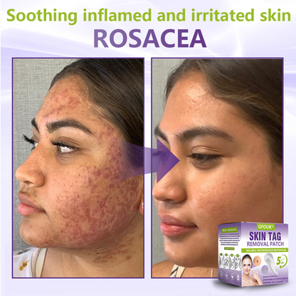 𝐎𝐟𝐟𝐢𝐜𝐢𝐚𝐥 𝐒𝐭𝐨𝐫𝐞 🇦🇺|🦘GFOUK® Soluble Microneedle Botanical Skin Tag Removal Patch