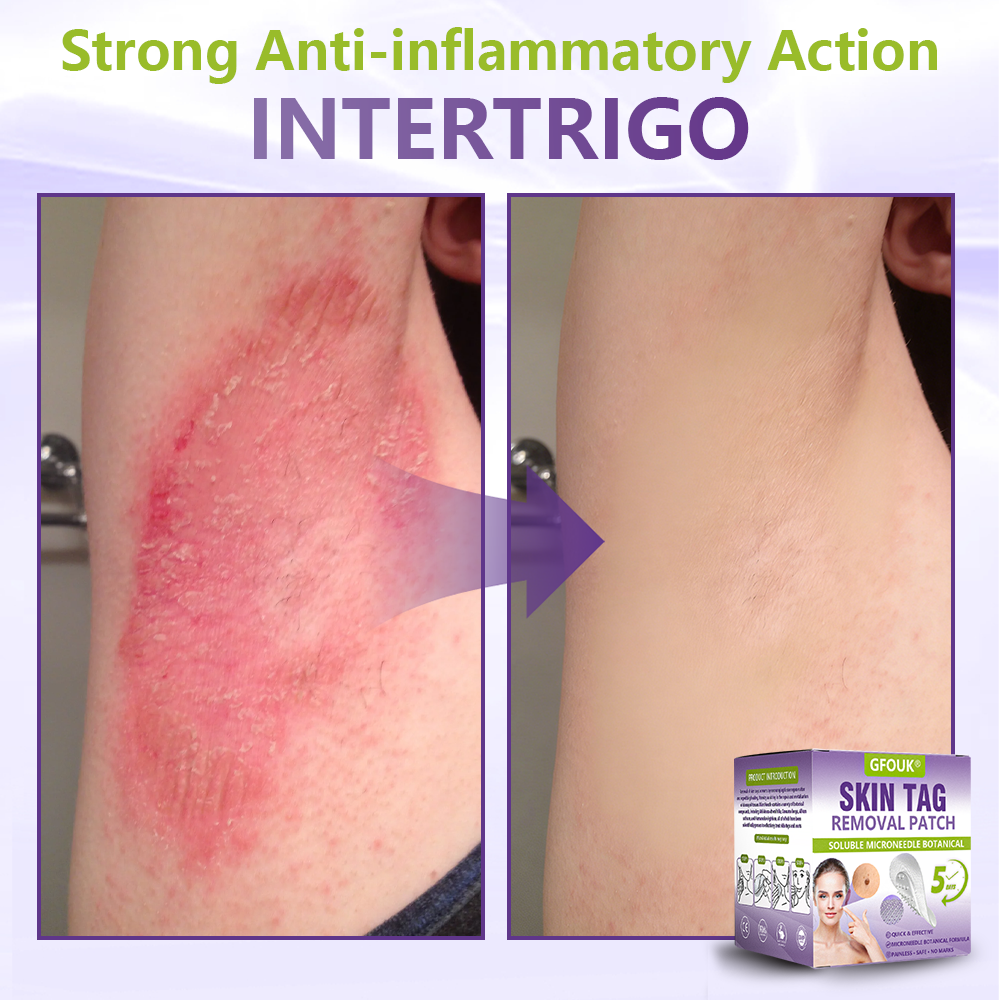 𝐎𝐟𝐟𝐢𝐜𝐢𝐚𝐥 𝐒𝐭𝐨𝐫𝐞 🇦🇺|🦘GFOUK® Soluble Microneedle Botanical Skin Tag Removal Patch