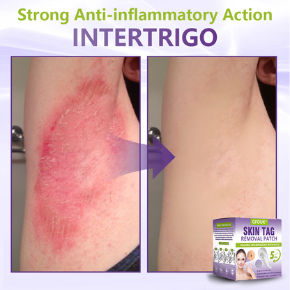 𝐎𝐟𝐟𝐢𝐜𝐢𝐚𝐥 𝐒𝐭𝐨𝐫𝐞 🇦🇺|🦘GFOUK® Soluble Microneedle Botanical Skin Tag Removal Patch