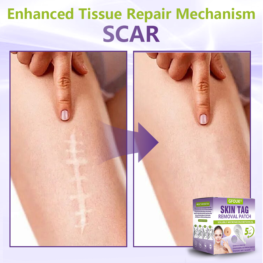 𝐎𝐟𝐟𝐢𝐜𝐢𝐚𝐥 𝐒𝐭𝐨𝐫𝐞 🇦🇺|🦘GFOUK® Soluble Microneedle Botanical Skin Tag Removal Patch