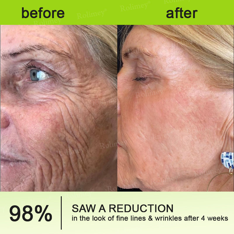 Made and shipped from Australia🦘Rolimey® Botox & Vita-A Retinol Shot Wrinkle-Lift Tightening cream - Last Day Promotion 70% OFF