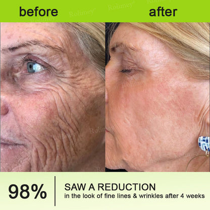 Made and shipped from Australia🦘Rolimey® Botox & Vita-A Retinol Shot Wrinkle-Lift Tightening cream - Last Day Promotion 70% OFF