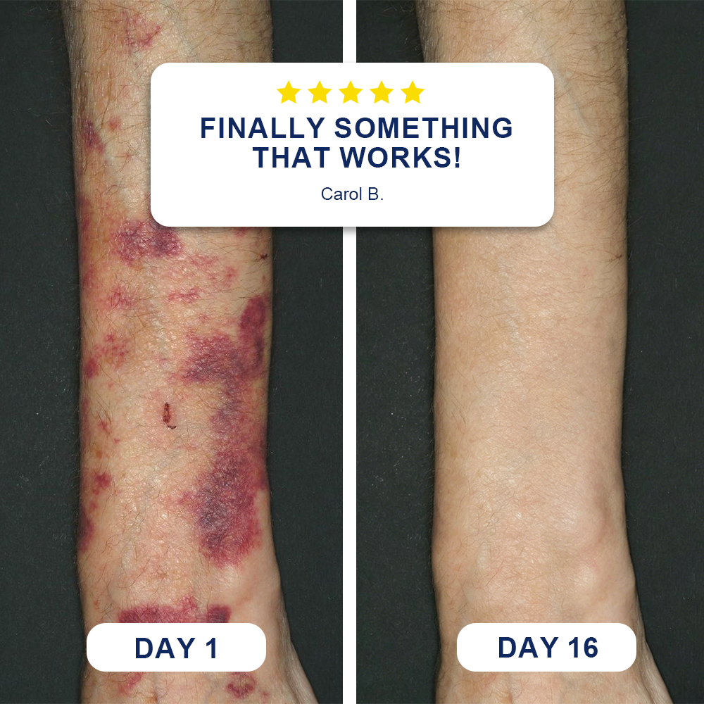 🦘❤️❤️❤️Evolvion® Bruise Repair & Skin-Strengthening Cream