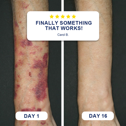 🦘❤️❤️❤️Evolvion® Bruise Repair & Skin-Strengthening Cream