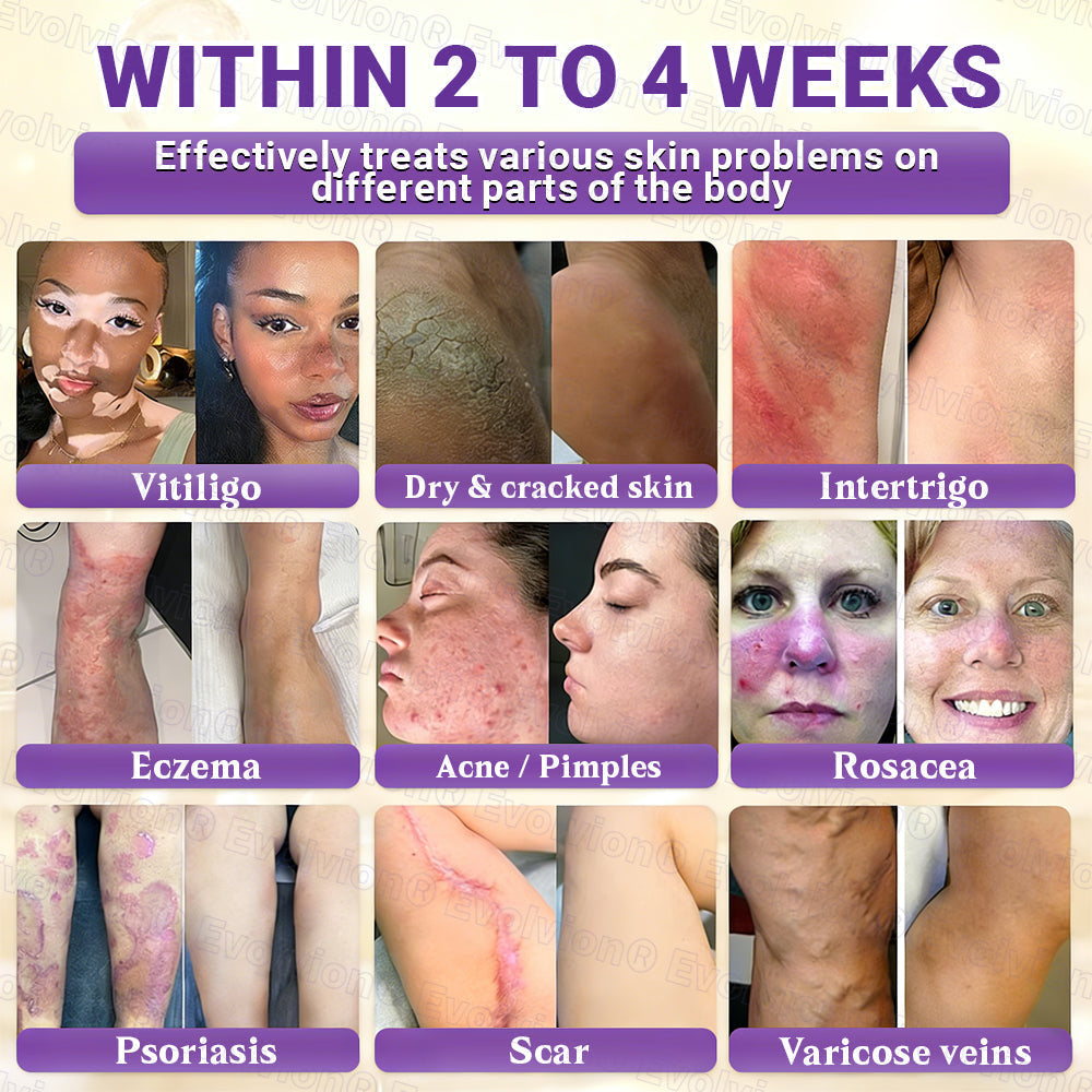 Made and Shipped from Australia🦘🔖Evolvion® Biotin 10-in-1 All-in-One Barrier Repair Cream - Last Day Promotion: 50% OFF