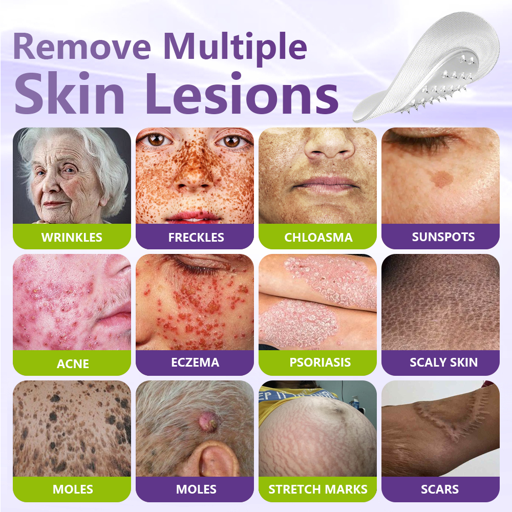 𝐎𝐟𝐟𝐢𝐜𝐢𝐚𝐥 𝐒𝐭𝐨𝐫𝐞 🇦🇺|🦘GFOUK® Soluble Microneedle Botanical Skin Tag Removal Patch