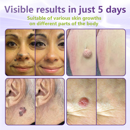 𝐎𝐟𝐟𝐢𝐜𝐢𝐚𝐥 𝐒𝐭𝐨𝐫𝐞 🇦🇺|🦘GFOUK® Soluble Microneedle Botanical Skin Tag Removal Patch