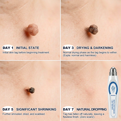 Made and Shipped from Australia🦘Evolvion® 𝟕-𝐃𝒂𝘆 𝐒𝗸𝐢𝐧 𝐓𝒂𝗴 & 𝐒𝐩𝙤𝐭 𝐄𝐫𝒂𝐬𝙚𝐫 Painless & Scar-Free Advanced Imperfection Remova𝗜 Ro𝗜𝗜erba𝗜𝗜 Pen