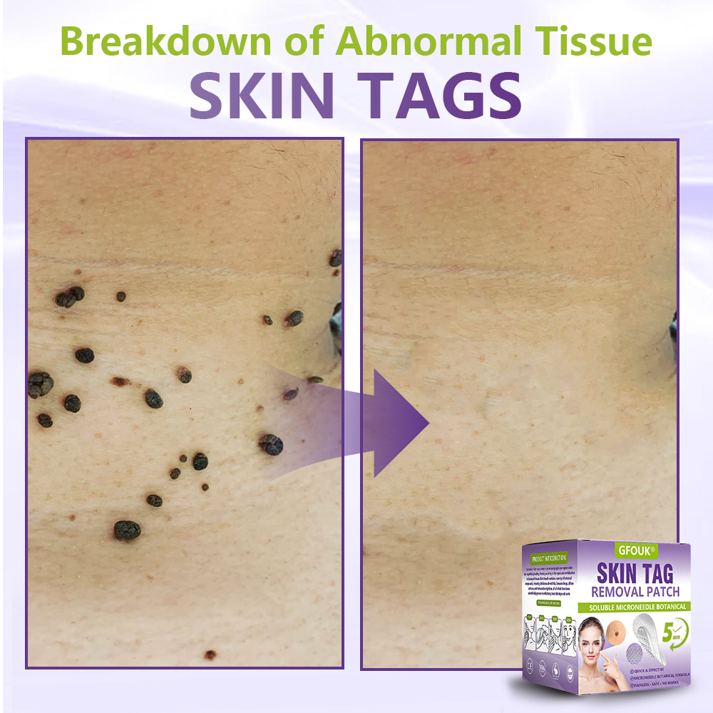 𝐎𝐟𝐟𝐢𝐜𝐢𝐚𝐥 𝐒𝐭𝐨𝐫𝐞 🇦🇺|🦘GFOUK® Soluble Microneedle Botanical Skin Tag Removal Patch