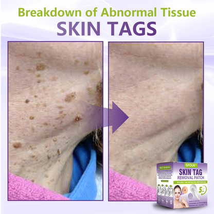 𝐎𝐟𝐟𝐢𝐜𝐢𝐚𝐥 𝐒𝐭𝐨𝐫𝐞 🇦🇺|🦘GFOUK® Soluble Microneedle Botanical Skin Tag Removal Patch