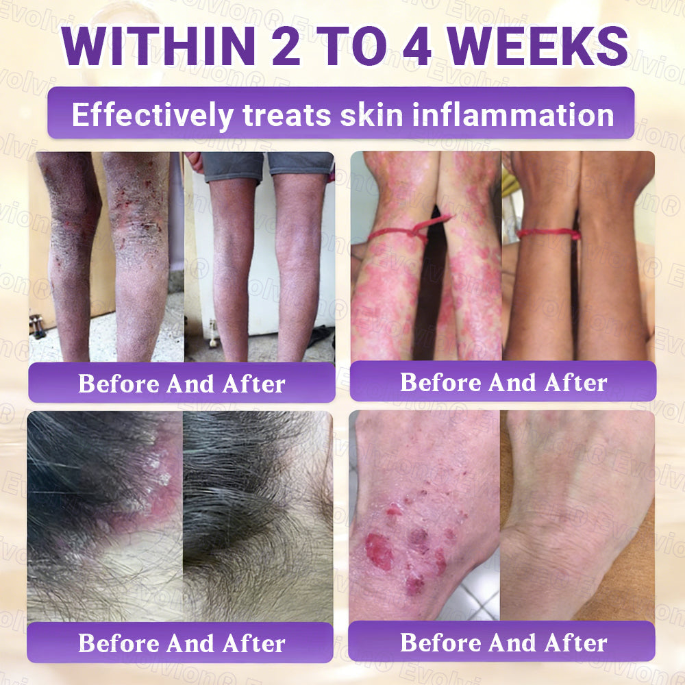Made and Shipped from Australia🦘🔖Evolvion® Biotin 10-in-1 All-in-One Barrier Repair Cream - Last Day Promotion: 50% OFF