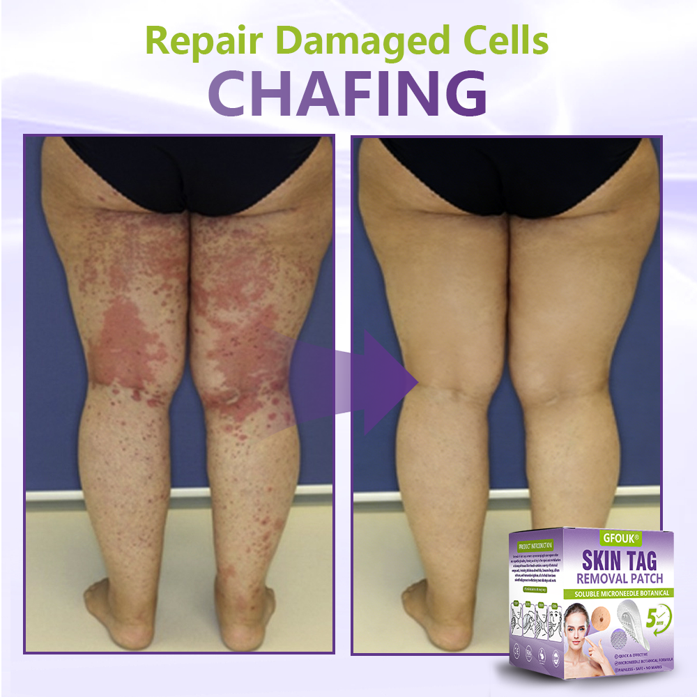 𝐎𝐟𝐟𝐢𝐜𝐢𝐚𝐥 𝐒𝐭𝐨𝐫𝐞 🇦🇺|🦘GFOUK® Soluble Microneedle Botanical Skin Tag Removal Patch