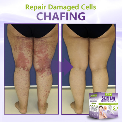 𝐎𝐟𝐟𝐢𝐜𝐢𝐚𝐥 𝐒𝐭𝐨𝐫𝐞 🇦🇺|🦘GFOUK® Soluble Microneedle Botanical Skin Tag Removal Patch