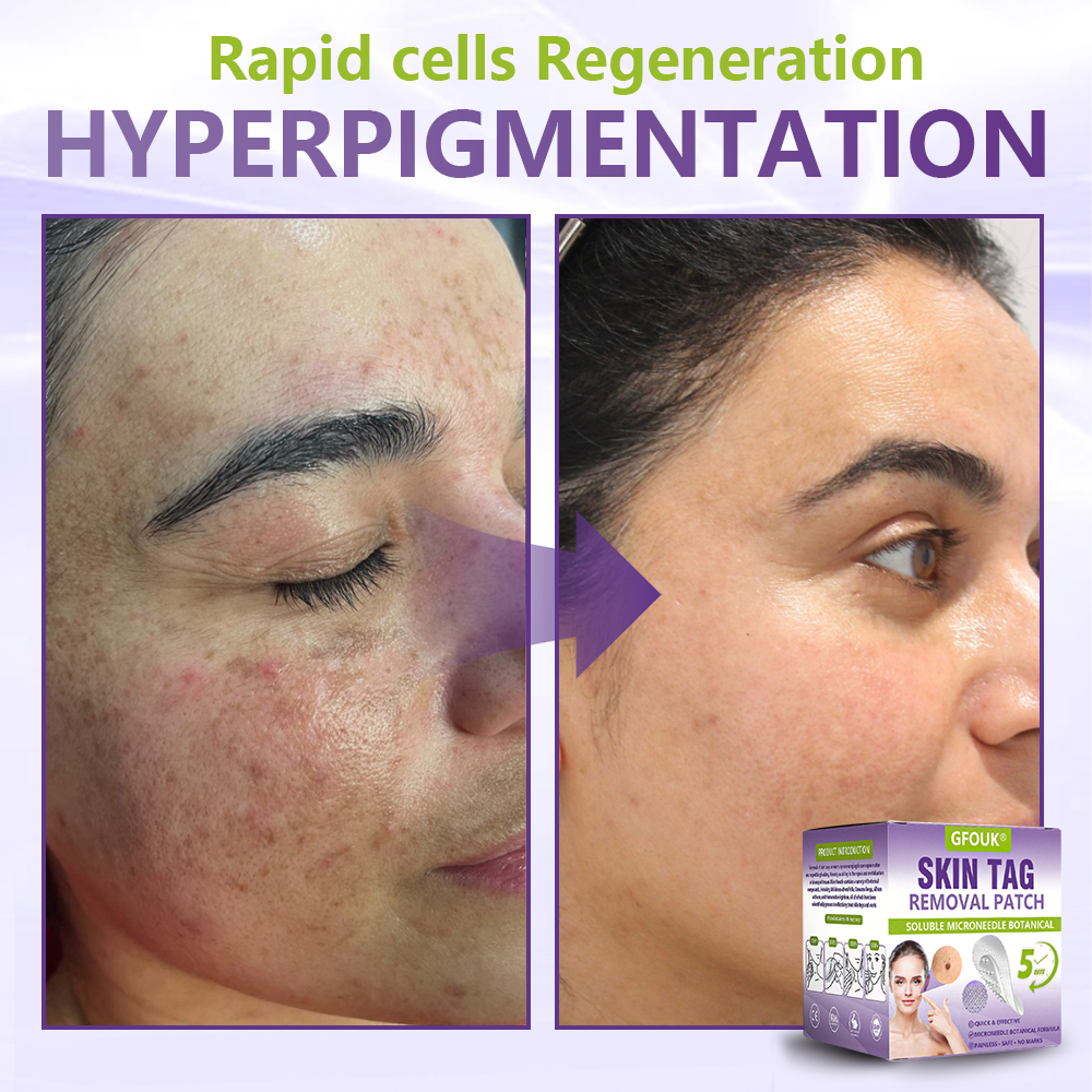 𝐎𝐟𝐟𝐢𝐜𝐢𝐚𝐥 𝐒𝐭𝐨𝐫𝐞 🇦🇺|🦘GFOUK® Soluble Microneedle Botanical Skin Tag Removal Patch
