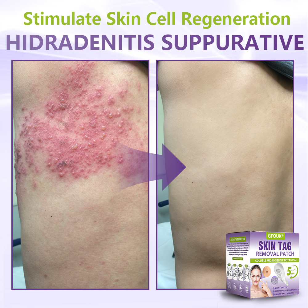 𝐎𝐟𝐟𝐢𝐜𝐢𝐚𝐥 𝐒𝐭𝐨𝐫𝐞 🇦🇺|🦘GFOUK® Soluble Microneedle Botanical Skin Tag Removal Patch