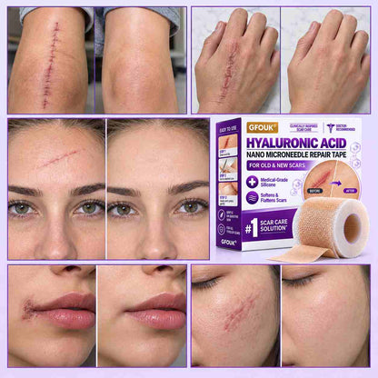 ✅GFOUK® Hyaluronic Acid Nano Microneedle Repair Tape🦘