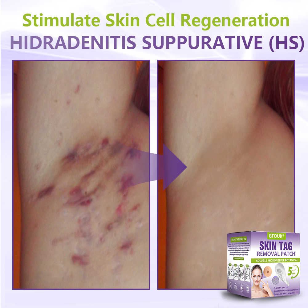 𝐎𝐟𝐟𝐢𝐜𝐢𝐚𝐥 𝐒𝐭𝐨𝐫𝐞 🇦🇺|🦘GFOUK® Soluble Microneedle Botanical Skin Tag Removal Patch