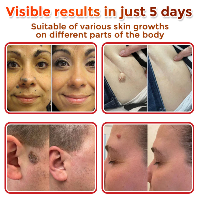 ❤️GFOUK® MicroNeedle Skin Tag Remover Patches - Botanic Formula | Fast Acting Australia