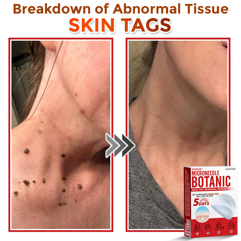 ❤️GFOUK® MicroNeedle Skin Tag Remover Patches - Botanic Formula | Fast Acting Australia