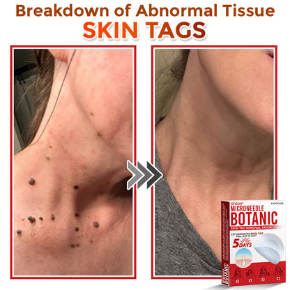 ❤️GFOUK® MicroNeedle Skin Tag Remover Patches - Botanic Formula | Fast Acting Australia