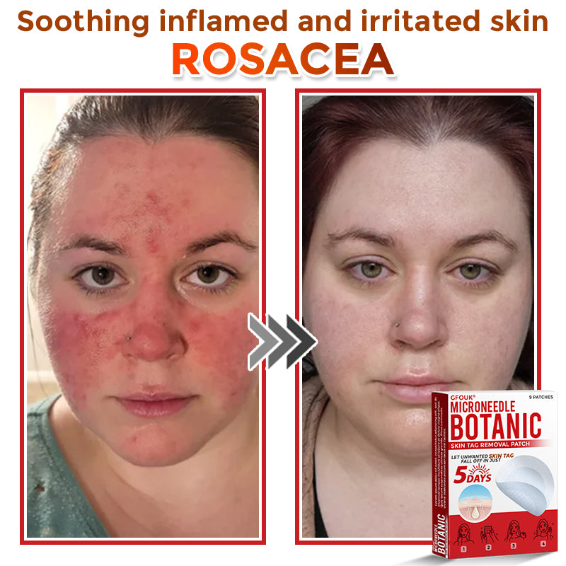 ❤️GFOUK® MicroNeedle Skin Tag Remover Patches - Botanic Formula | Fast Acting Australia
