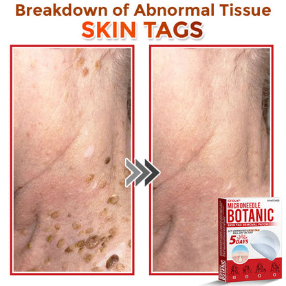 ❤️GFOUK® MicroNeedle Skin Tag Remover Patches - Botanic Formula | Fast Acting Australia