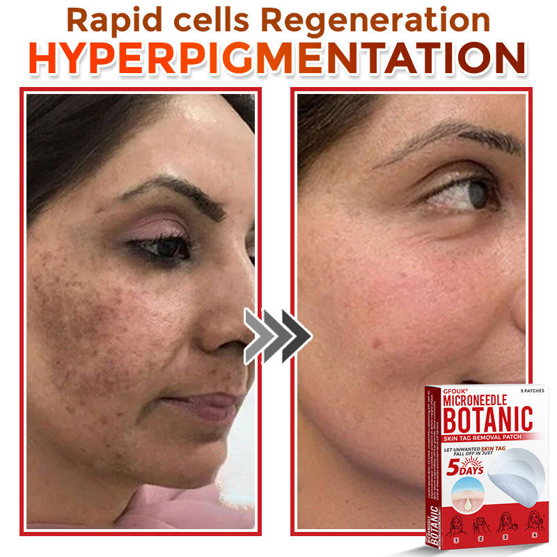 ❤️GFOUK® MicroNeedle Skin Tag Remover Patches - Botanic Formula | Fast Acting Australia