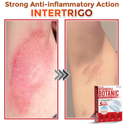 ❤️GFOUK® MicroNeedle Skin Tag Remover Patches - Botanic Formula | Fast Acting Australia