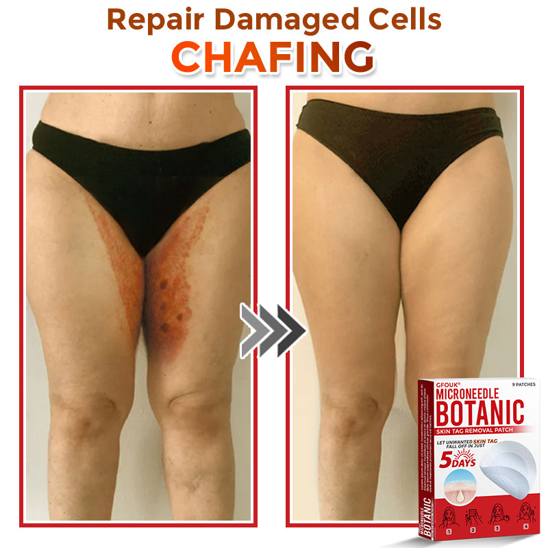 ❤️GFOUK® MicroNeedle Skin Tag Remover Patches - Botanic Formula | Fast Acting Australia