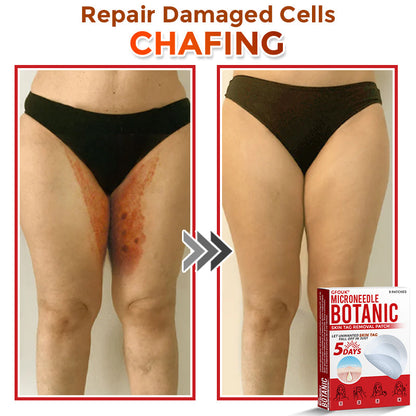 ❤️GFOUK® MicroNeedle Skin Tag Remover Patches - Botanic Formula | Fast Acting Australia