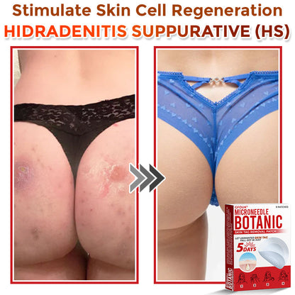 ❤️GFOUK® MicroNeedle Skin Tag Remover Patches - Botanic Formula | Fast Acting Australia