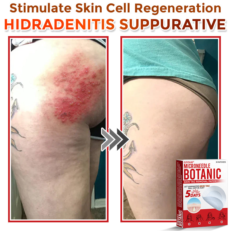 ❤️GFOUK® MicroNeedle Skin Tag Remover Patches - Botanic Formula | Fast Acting Australia