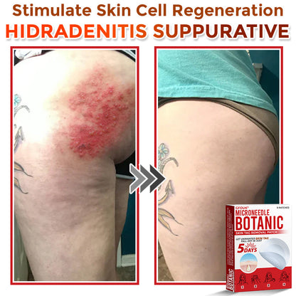 ❤️GFOUK® MicroNeedle Skin Tag Remover Patches - Botanic Formula | Fast Acting Australia